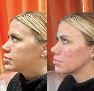 Face of a woman before and after a Dermal Filler treatment | Sculpted Aesthetics in Columbia, SC