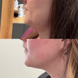 Face of a woman before and after a Kybella treatment | Sculpted Aesthetics in Columbia, SC