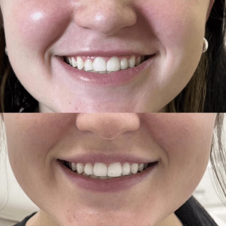 Face of a woman before and after a Lip Flip treatment | Sculpted Aesthetics in Columbia, SC