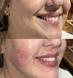 Face of a woman before and after a PDO Smooth Threads treatment | Sculpted Aesthetics in Columbia, SC