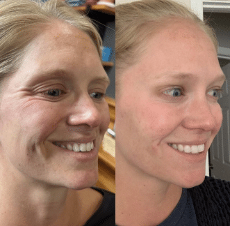 Face of a woman before and after a Sculptra treatment | Sculpted Aesthetics in Columbia, SC