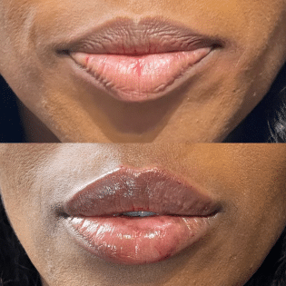 Face of a woman before and after a Lip Enhancement treatment | Sculpted Aesthetics in Columbia, SC