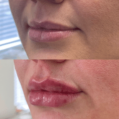 Face of a woman before and after a Lip Enhancement treatment | Sculpted Aesthetics in Columbia, SC