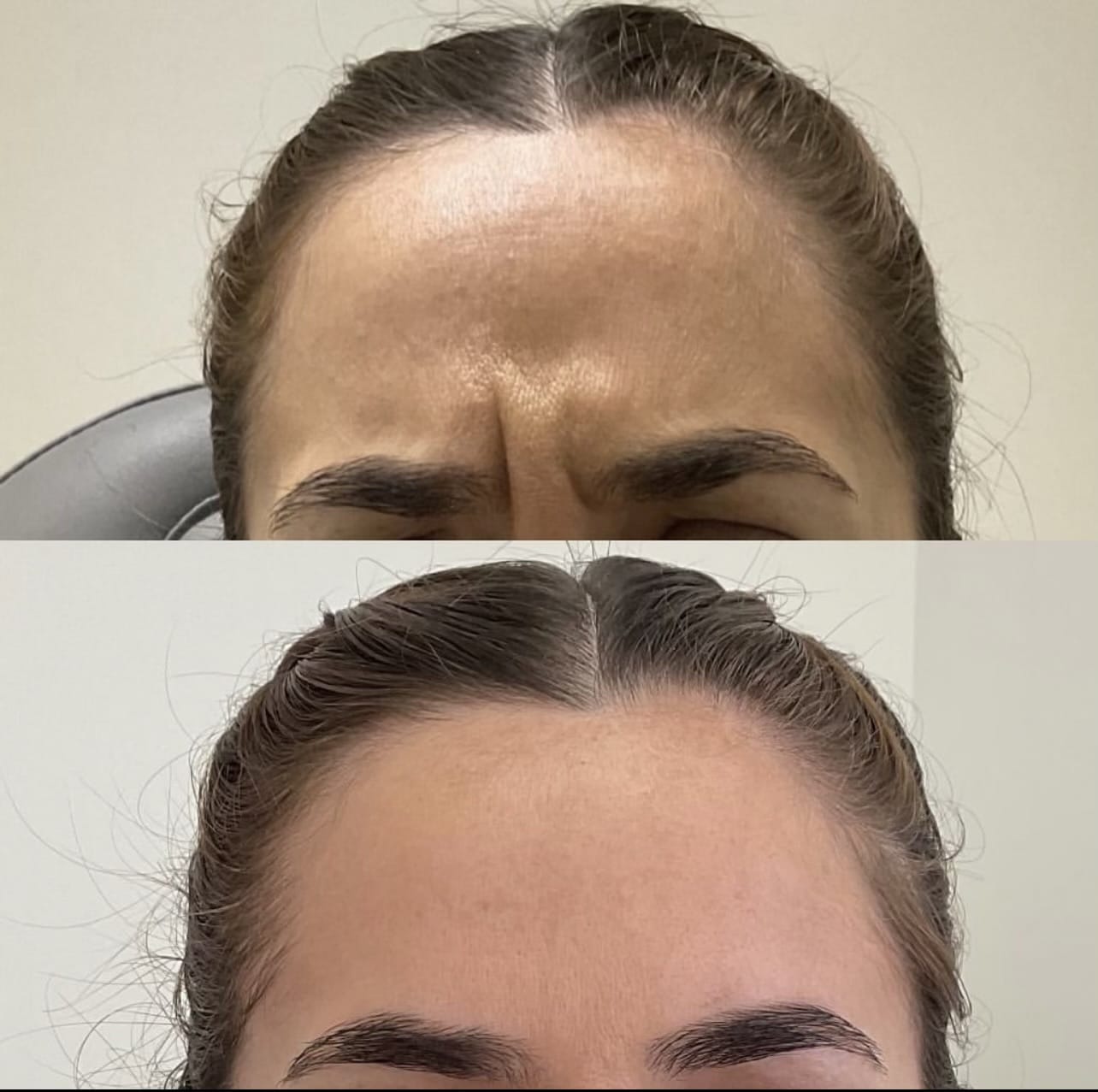 Face of a woman before and after a botox treatment to smooth expression lines. Concept of anti-aging and rejuvenation cosmetics on forehead wrinkles | Sculpted Aesthetics in Columbia, SC