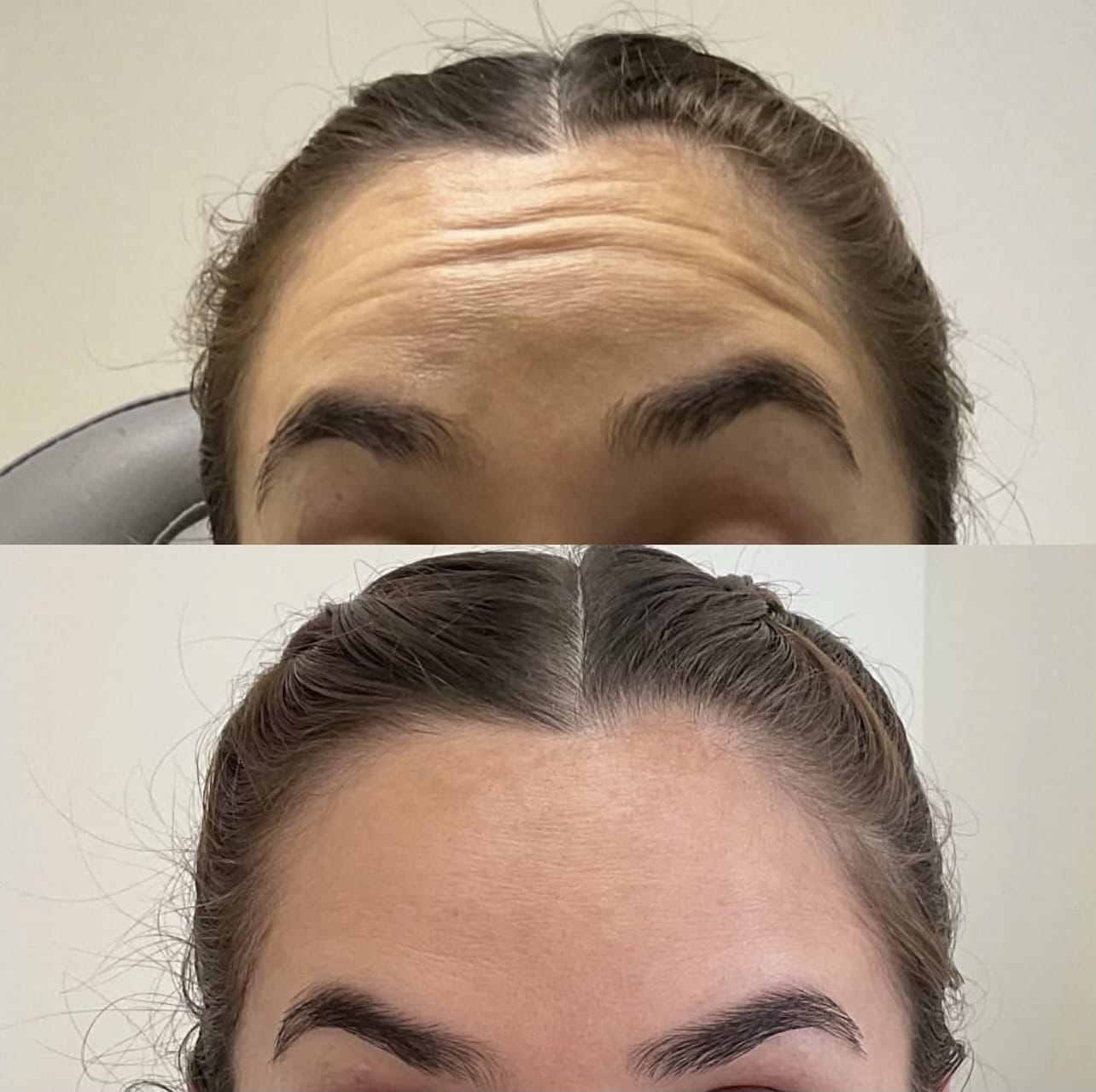 Face of a woman before and after a botox treatment to smooth expression lines. Concept of anti-aging and rejuvenation cosmetics on forehead wrinkles | Sculpted Aesthetics in Columbia, SC