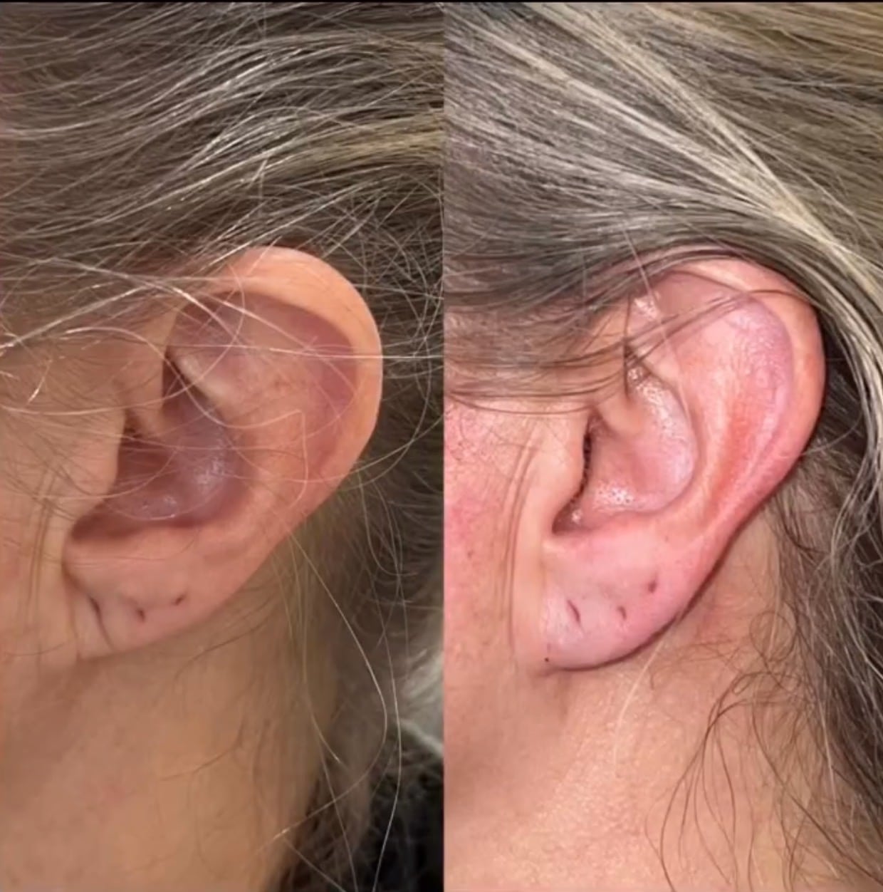 Results of Young Female Face with Ear Piercing treatment before and after | Sculpted Aesthetics in Columbia, SC