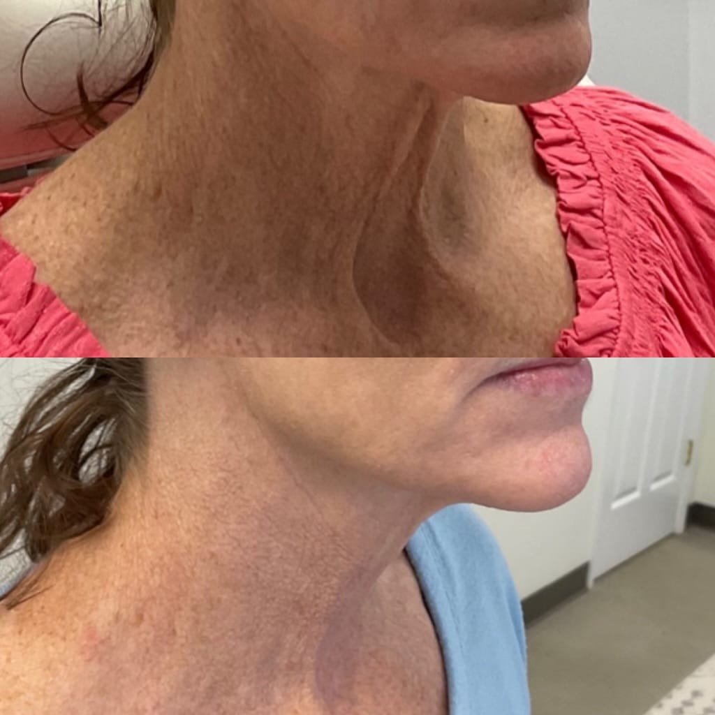 Face of a woman before and after a Hyperdilute Radiesse cosmetic treatment | Sculpted Aesthetics in Columbia, SC
