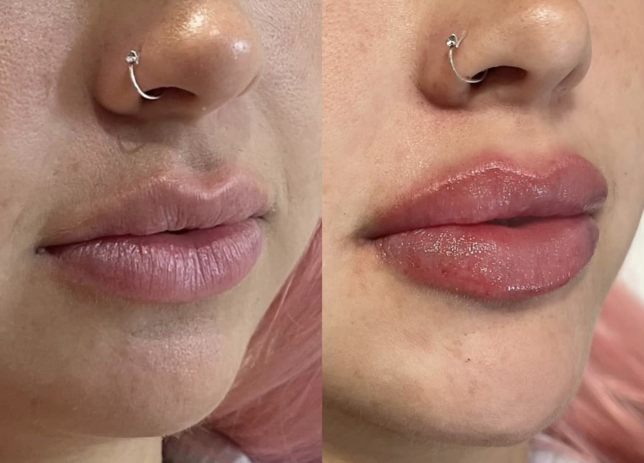 Photo before and after Lip Enhancement Complex Treatment for Lips | Sculpted Aesthetics in Columbia