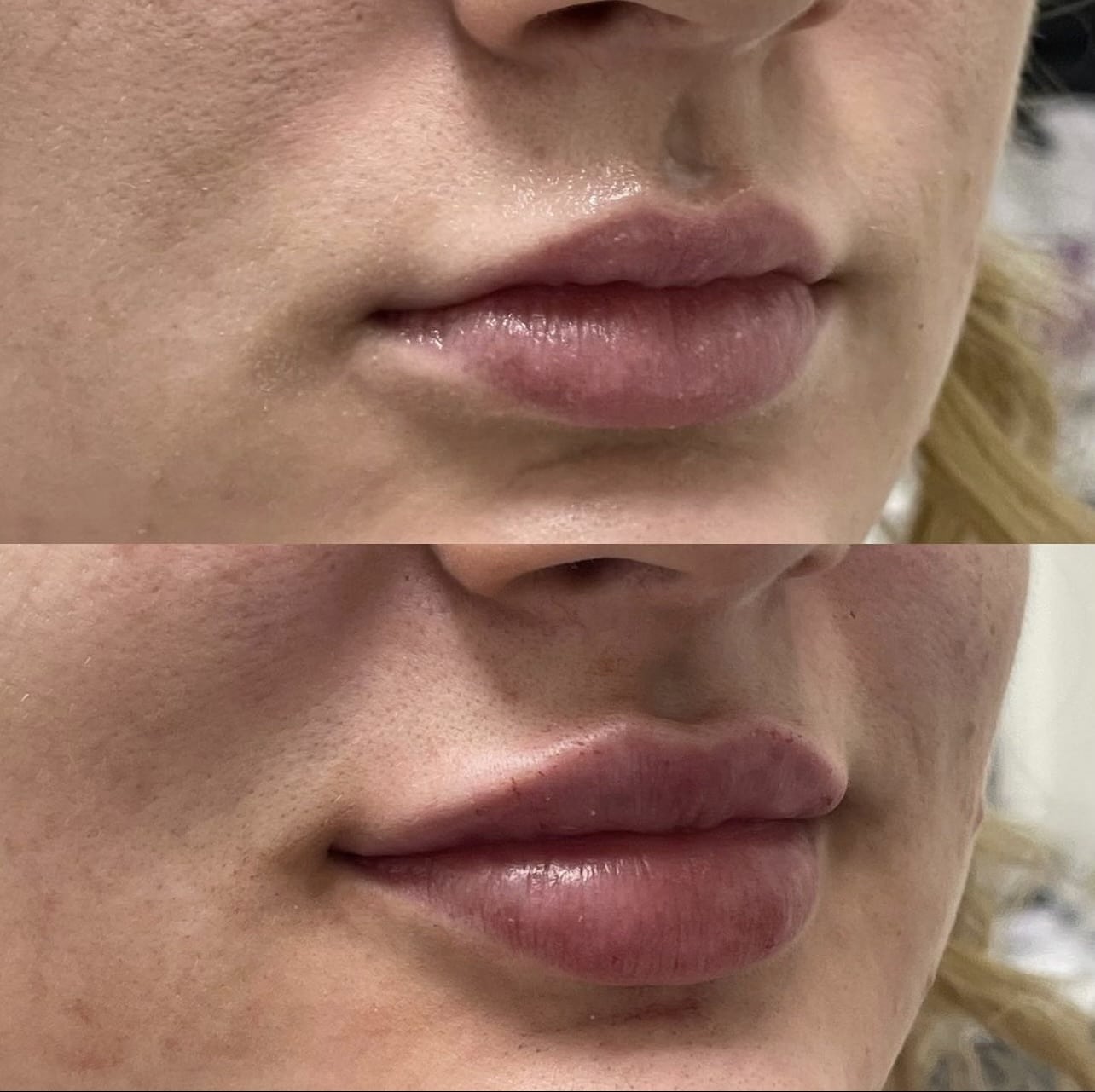 Photo before and after Lip Enhancement Complex Treatment for Lips | Sculpted Aesthetics in Columbia, SC