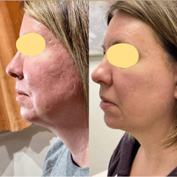 Acne Treatment using Aerolase Before After Treatment | Sculpted Aesthetics in Columbia, SC