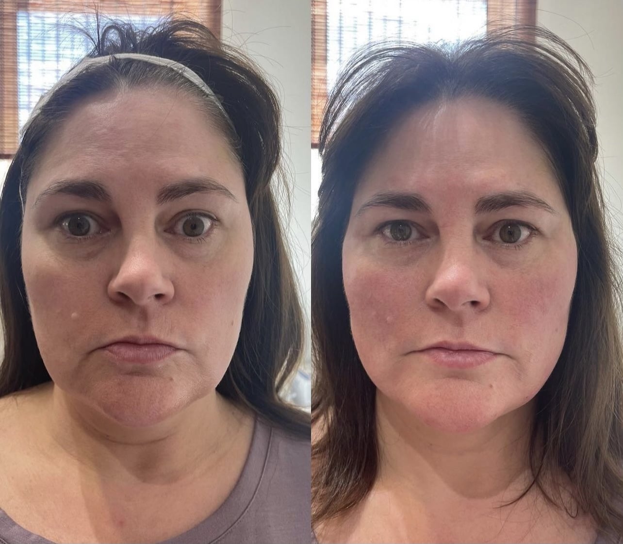 Microneedling with PDO AfterGlo, Microneedle RF lifting procedure. Hardware cosmetology. Beautician conducts a facial rejuvenation procedure for a Young woman, PDO Thread Lift Before After | Sculpted Aesthetics in Columbia, SC