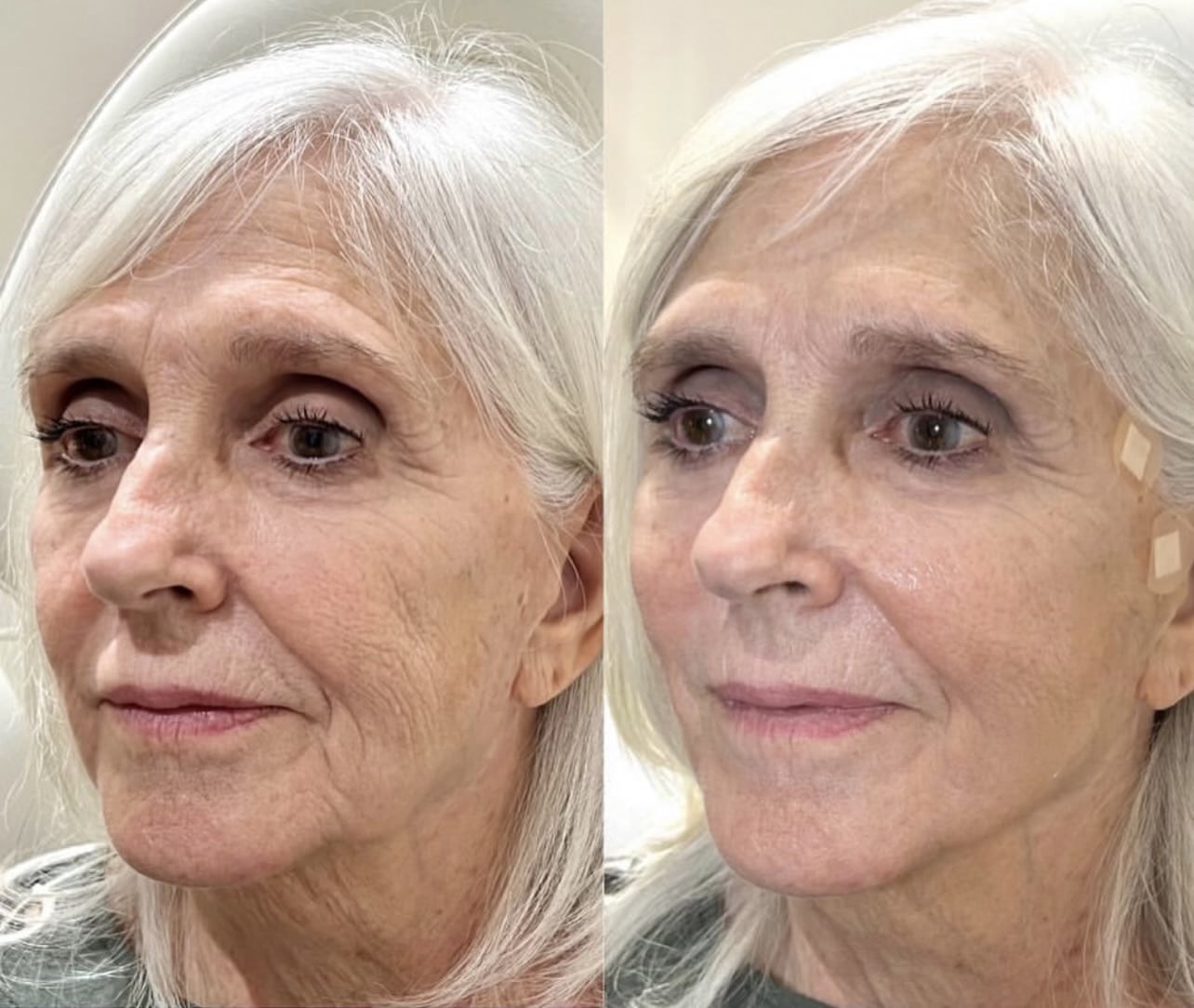 Microneedling with PDO AfterGlo, Microneedle RF lifting procedure. Hardware cosmetology. Beautician conducts a facial rejuvenation procedure for a Old woman, PDO Thread Lift Before After | Sculpted Aesthetics in Columbia, SC