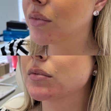Acne Treatment using Aerolase Before After Treatment | Sculpted Aesthetics in Columbia, SC