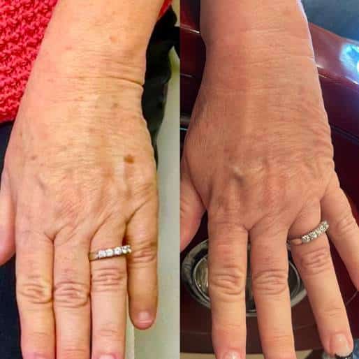 Forever Young BBL treatment for Hand before and after | Sculpted Aesthetics in Columbia, SC