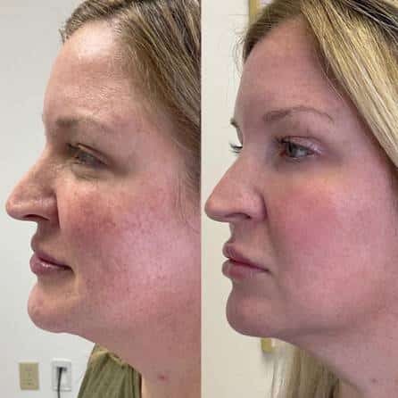 Young Female Getting bbl moxi laser treatment before and after | Sculpted Aesthetics in Columbia, SC