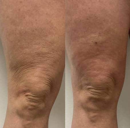 Hyperdilute Radiesse treatment for Leg before and after | Sculpted Aesthetics in Columbia, SC