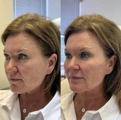 Microneedling with PDO AfterGlo, Microneedle RF lifting procedure. Hardware cosmetology. Beautician conducts a facial rejuvenation procedure for a Young woman, PDO Thread Lift Before After | Sculpted Aesthetics in Columbia, SC