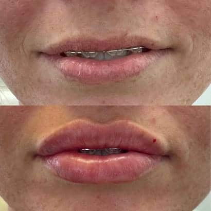 Photo before and after Lip Enhancement Complex Treatment for Lips | Sculpted Aesthetics in Columbia, SC