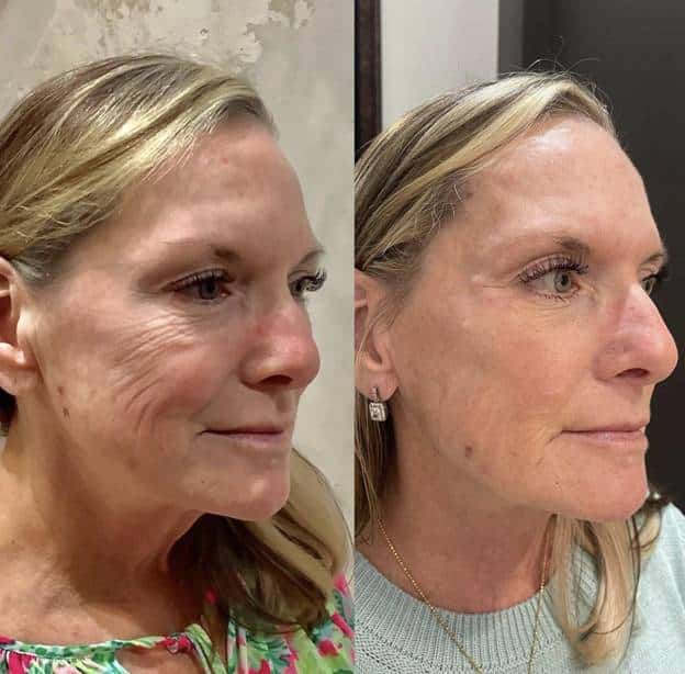 Microneedling with PDO Smooth Threads, Microneedle RF lifting procedure. Hardware cosmetology. Beautician conducts a facial rejuvenation procedure for a Young woman, PDO Thread Lift Before After | Sculpted Aesthetics in Columbia, SC
