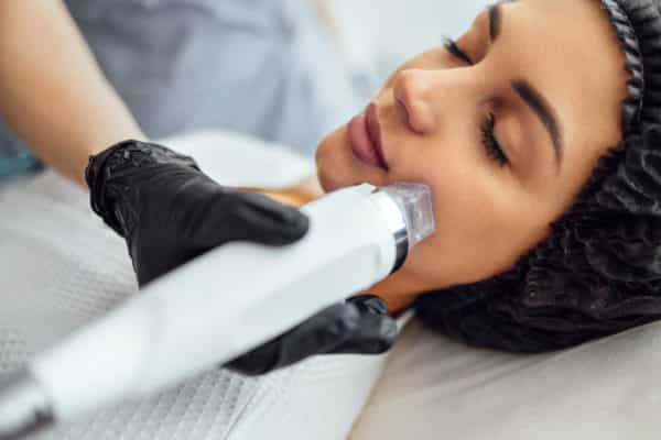 Microneedling with PDO AfterGlo, Microneedle RF lifting procedure. Hardware cosmetology. Beautician conducts a facial rejuvenation procedure for a brunette woman | Sculpted Aesthetics in Columbia, SC