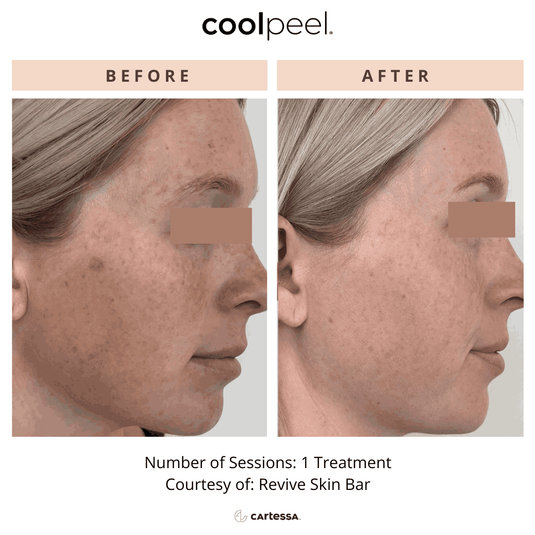 CoolPeel