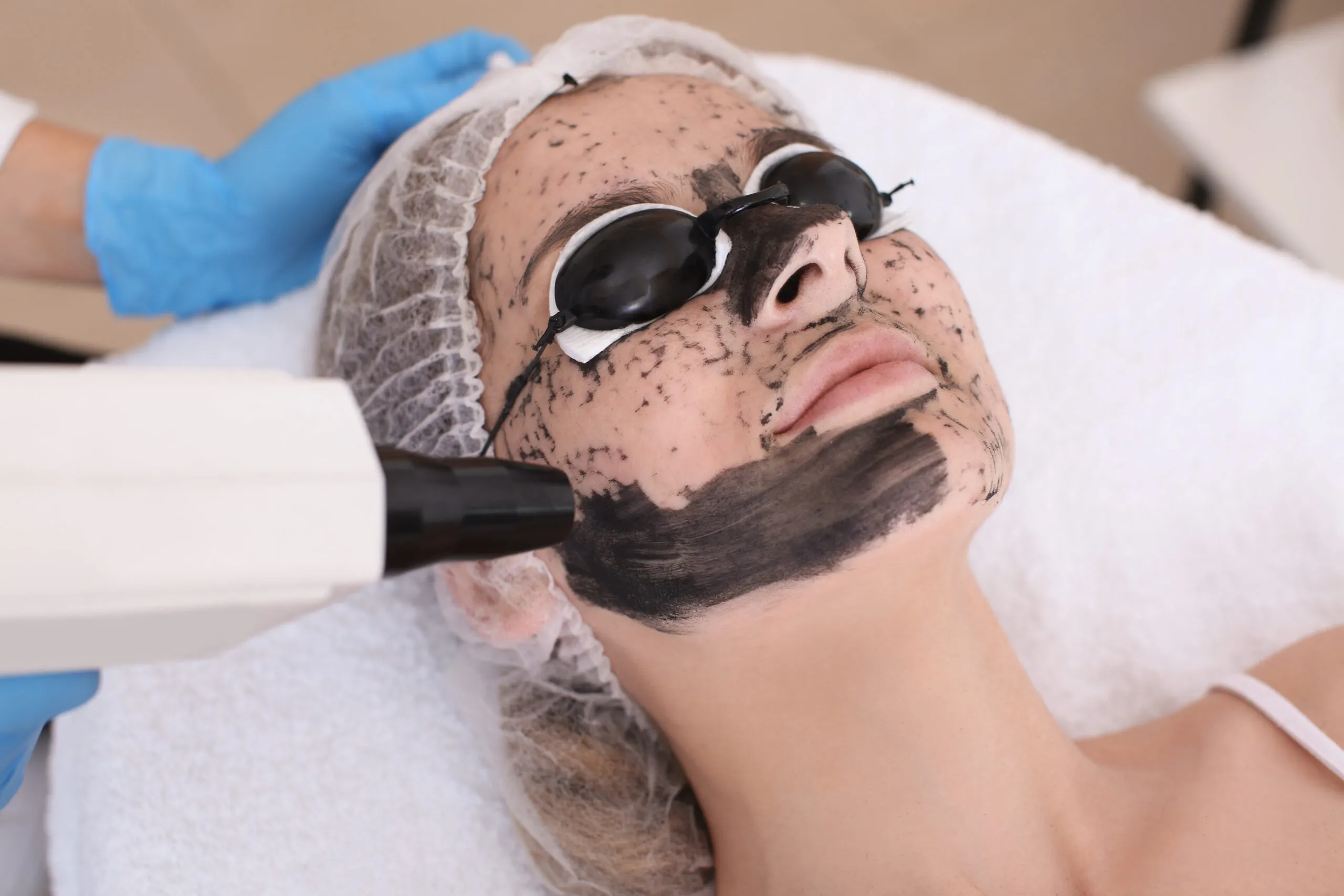NaturaPeel Laser Facial by Sculpted by WH Aesthetics in Columbia, SC