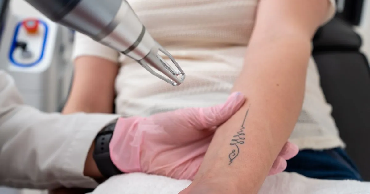 Laser Tattoo Removal on forearm in Columbia, SC