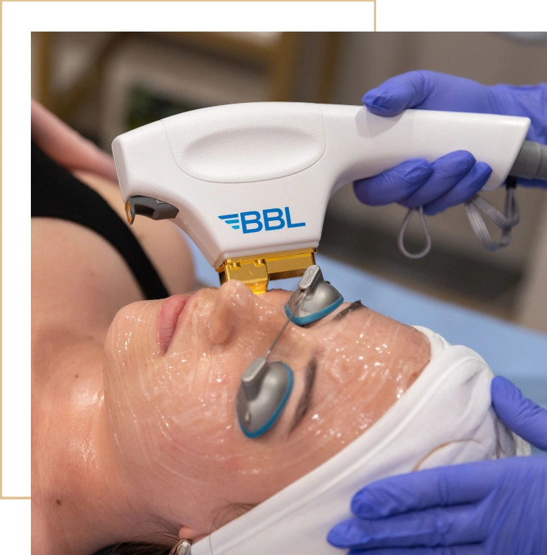 Defalted Bbl Sciton BBL HERO & MOXI Laser treatments in Columbia, SC
