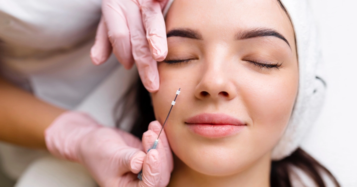 A woman with eyes closed receives a PDO Threads cosmetic treatment in Columbia, SC, as a gloved hand holds a needle near her cheek.