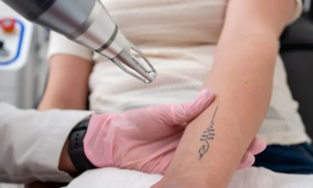 Laser Tattoo Removal on forearm in Columbia, SC